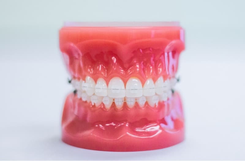 clear ceramic braces on plastic typodont