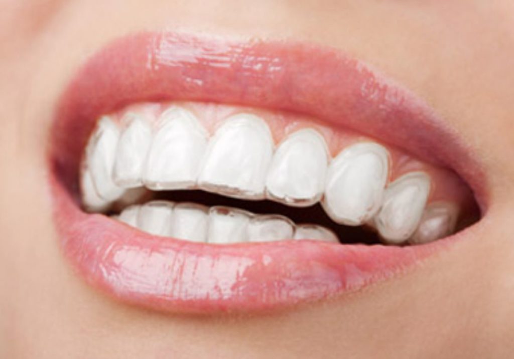 Fix Your Overbite With Invisalign